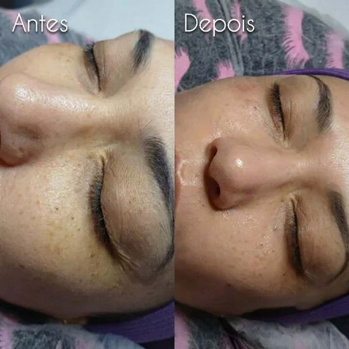 Antes e depois de microagulhamento facial